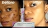 Adacin Gel Acne Treatment Pimples & Cystic Acne Spot Treatment