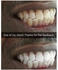 Advanced Teeth Whitening Kit