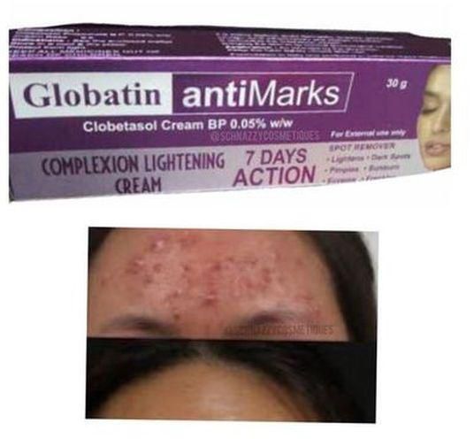 Gandour Globatin Antimarks Cream Pimples Eczema Spots Blemishes