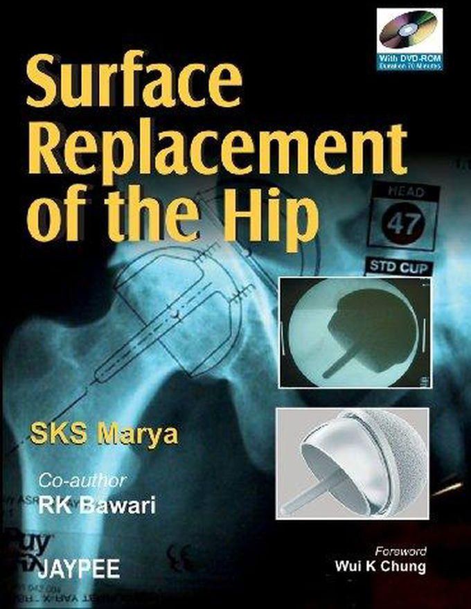 Surface Replacement of the Hip (With DVD-ROM) ,Ed. :1