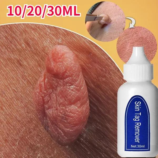 30ml Skin Tag Remover arrow Genital Wart Treatment Instant Removal Mole&Papillomas Foot Corn Repair Tool