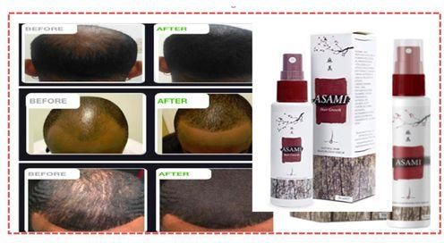 Asami Baldness Hair Growth Spray - Stop Baldness - Natural Way To Regrow Your Hair