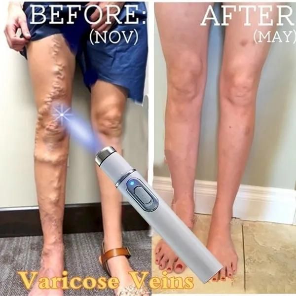 New Updated Medical Blue Light Therapy Varicose Veins Soft Scar Wrinkle Removal Treatment Pen