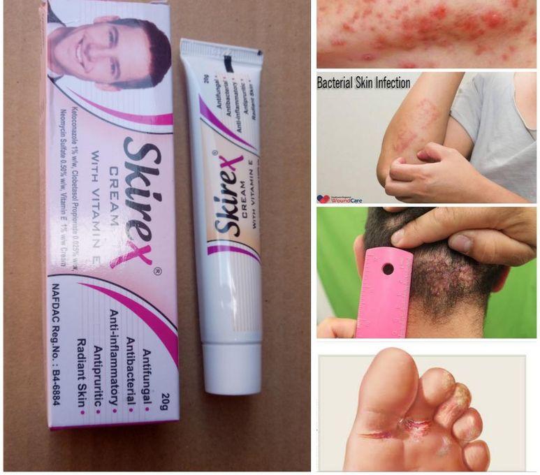 Skirex Cream For (Bacterial, Fungal, Inflammatory)