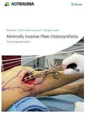 Generic Minimally Invasive Plate Osteosynthesis (Mipo) By Reto Babst, Suthorn Bavonratanavech, Rodrigo F. Pesantez