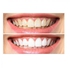 Advance Teeth Whitening