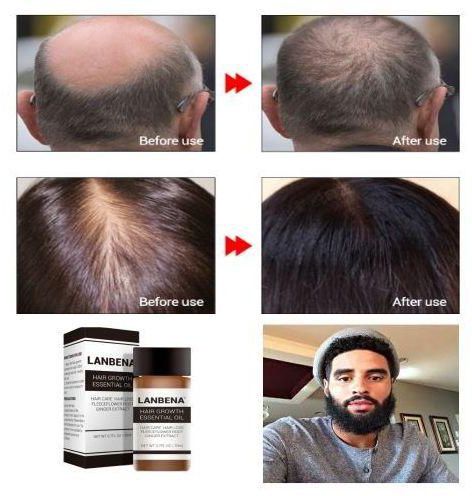 Lanbena Beard & Bald Head Repair, Hair Loss Cure - 10 Days Solution price  from jumia in Nigeria - Yaoota!
